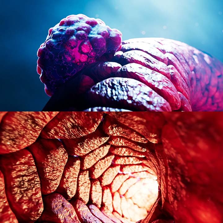 Cancer cell squeezing into a blood vessel (intravasation)