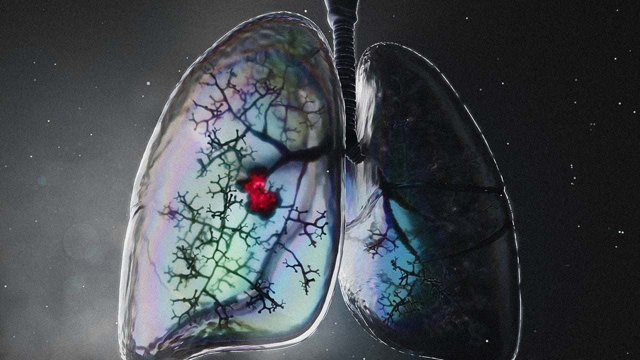 Lung Metastasis
